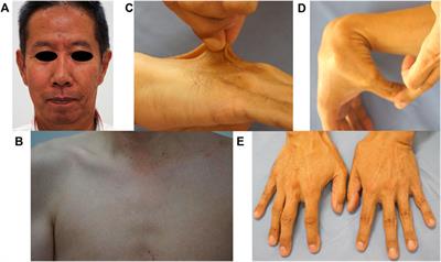 Case report: Mild phenotype of a patient with vascular Ehlers–Danlos syndrome and COL3A1 duplication mutation without alteration in the [Gly-X-Y] repeat sequence